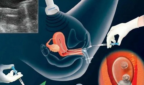 精子畸形怎么做泰国第三代试管婴儿？